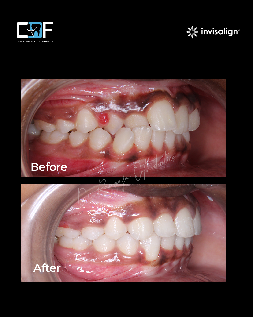 Before After Result